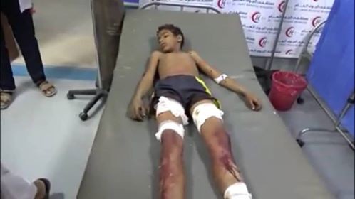 انفجار مقذوف حوثي يفتك بحياة طفل ويصيب شقيقه جنوبي الحديدة