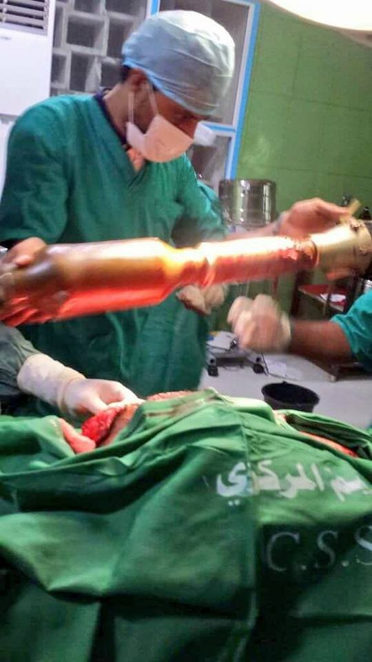 شاهد بالصورة، الأطباء يخرجون صاروخ حراري من جسد أحد افراد القوات المسلحة